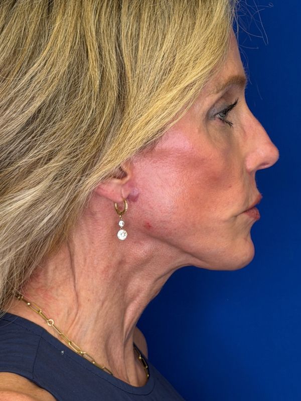 Facelift Before & After Image