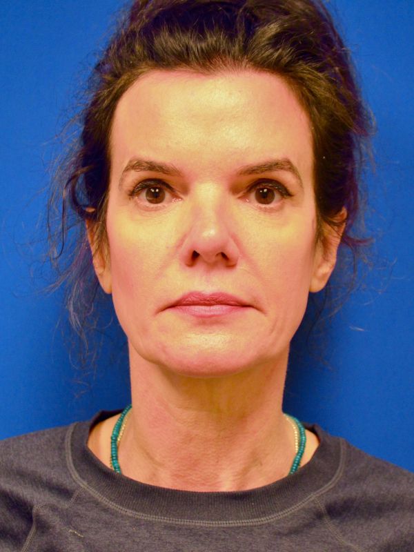 Facelift Before & After Image