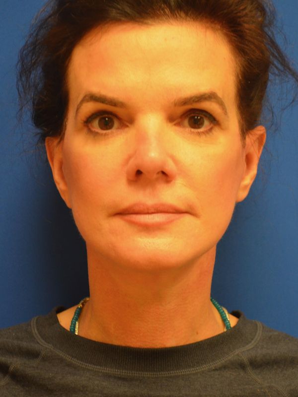 Facelift Before & After Image