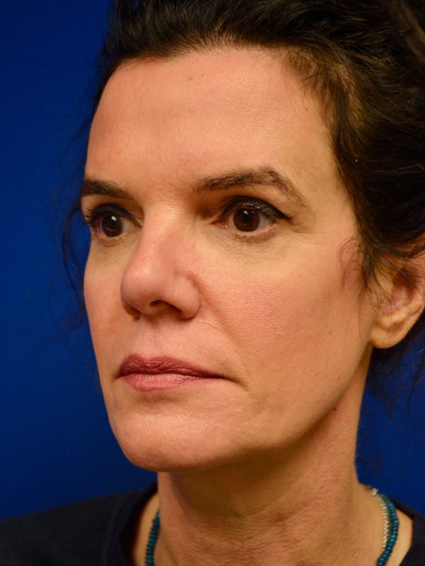 Facelift Before & After Image