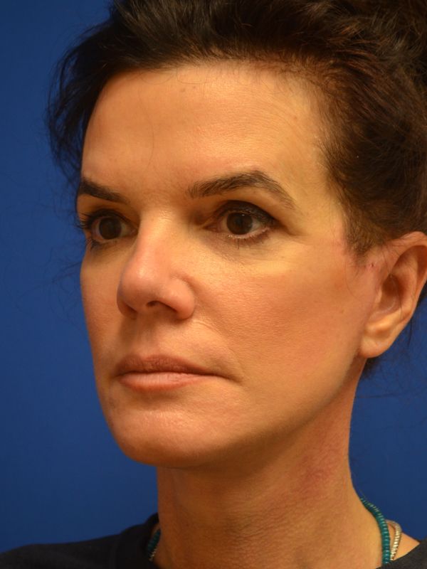 Facelift Before & After Image