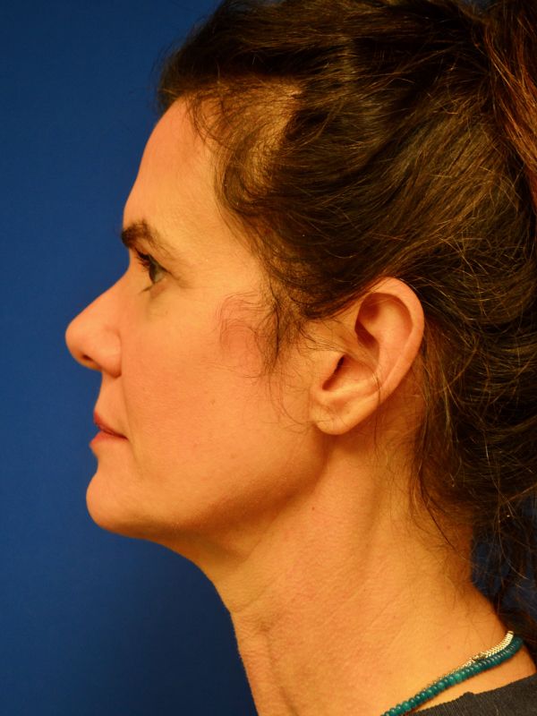 Facelift Before & After Image
