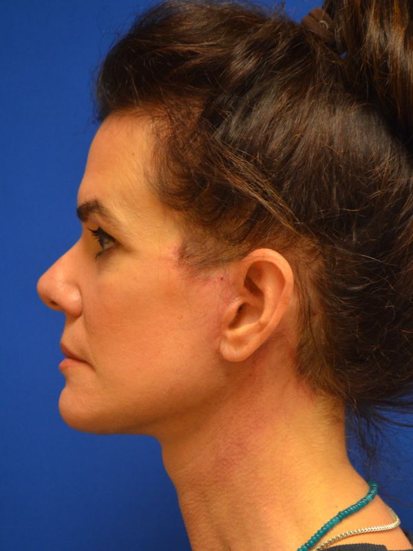 Facelift Before & After Image