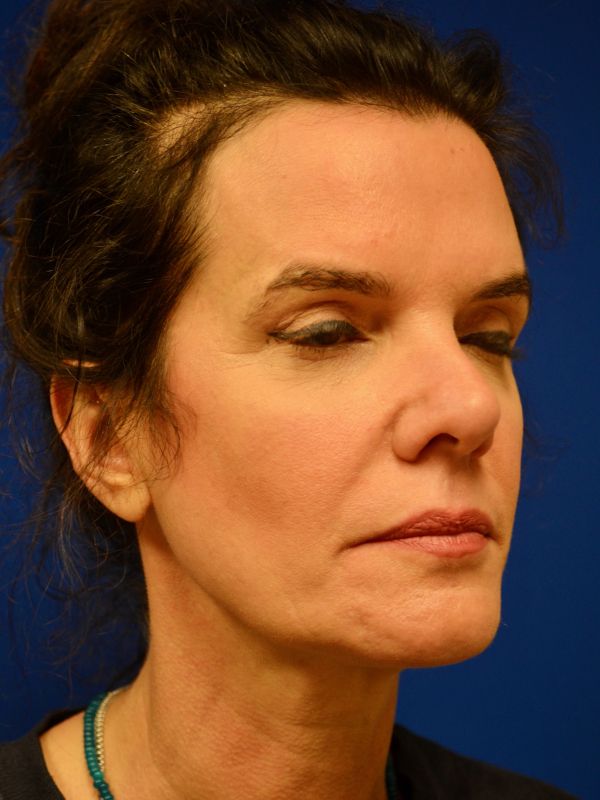 Facelift Before & After Image