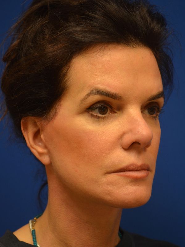 Facelift Before & After Image