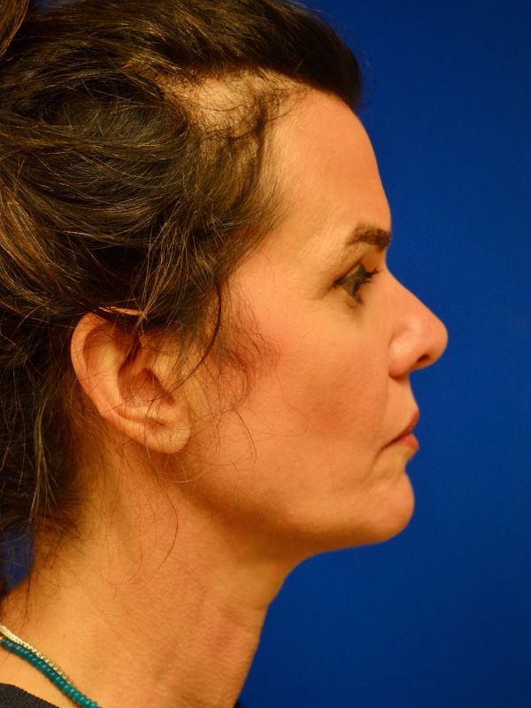 Facelift Before & After Image