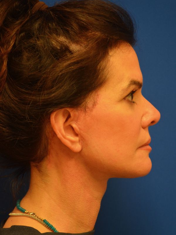 Facelift Before & After Image