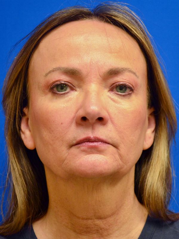 Facelift Before & After Image