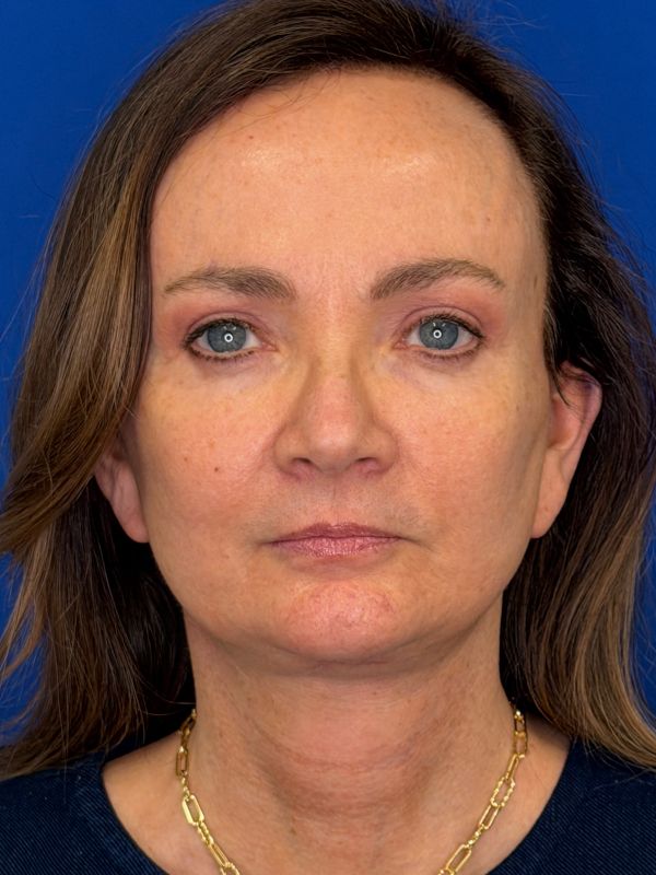 Facelift Before & After Image