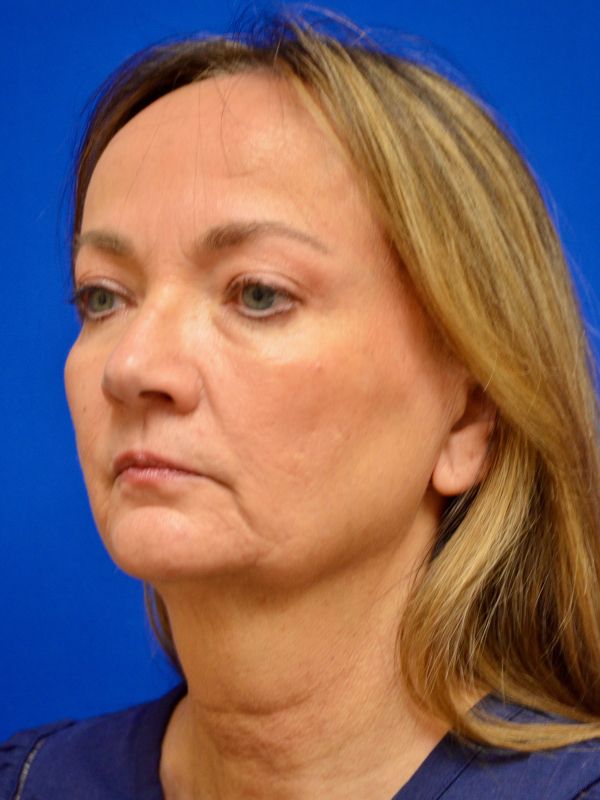 Facelift Before & After Image