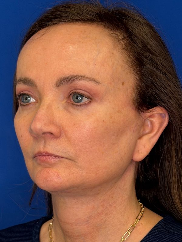 Facelift Before & After Image