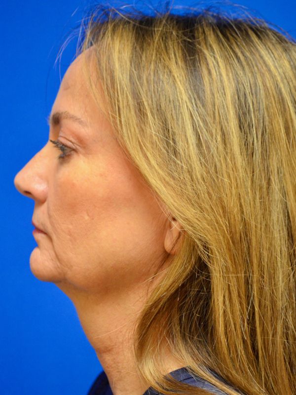 Facelift Before & After Image