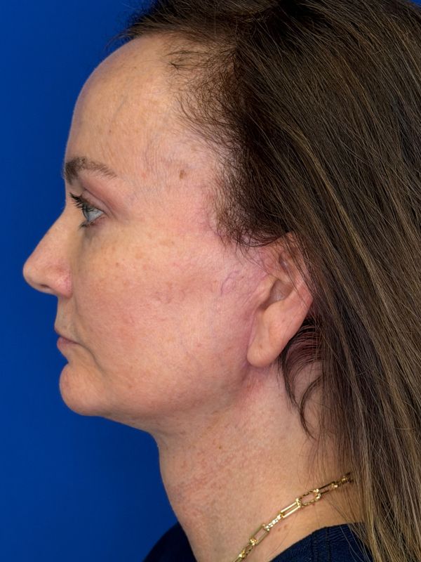 Facelift Before & After Image