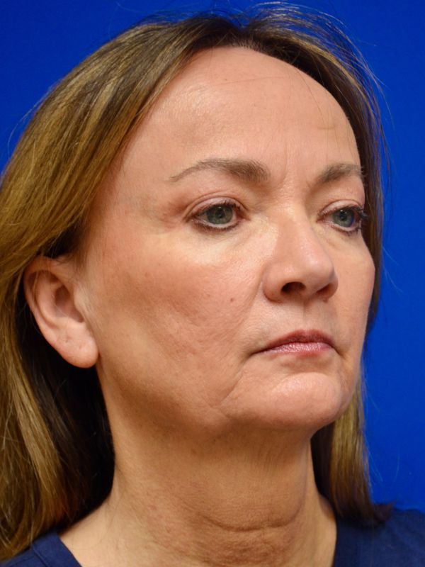 Facelift Before & After Image