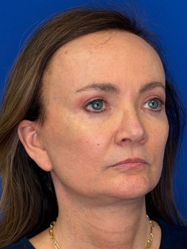 Facelift Before & After Image