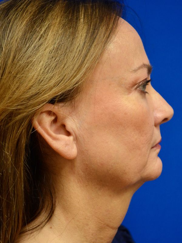 Facelift Before & After Image