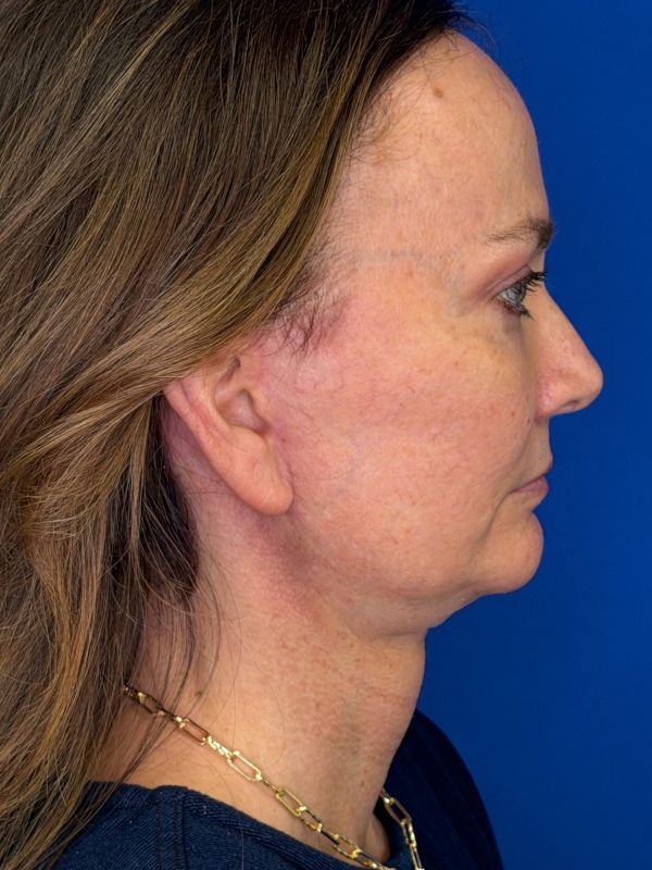 Facelift Before & After Image