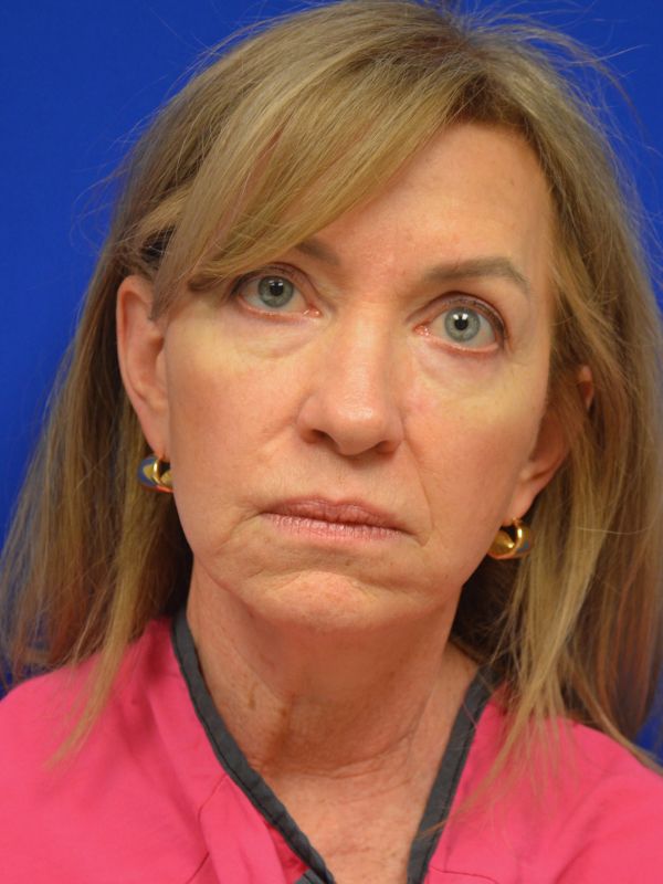 Facelift Before & After Image