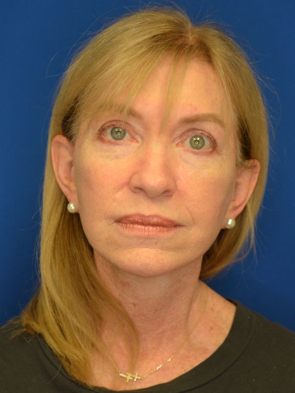 Facelift Before & After Image