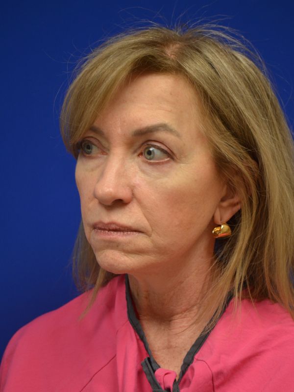 Facelift Before & After Image