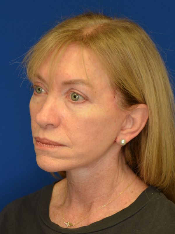 Facelift Before & After Image