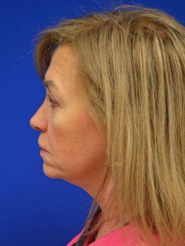 Facelift Before & After Image