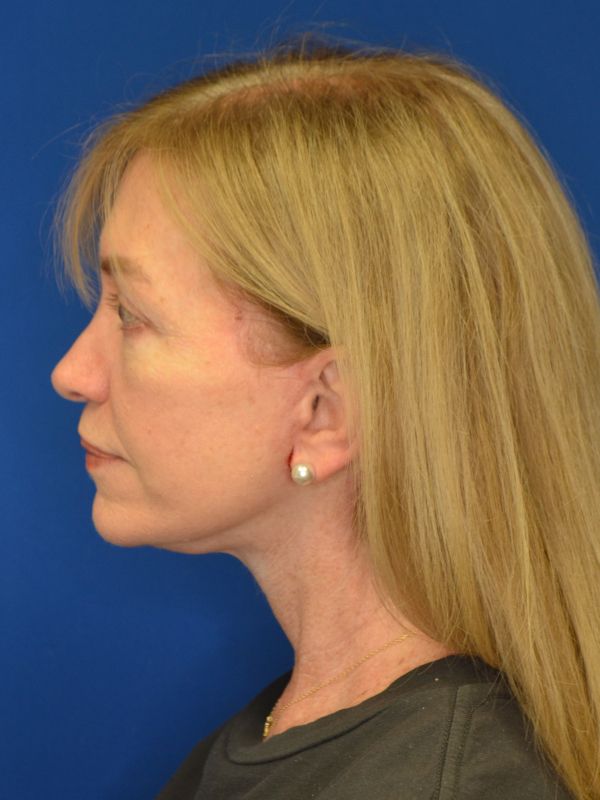Facelift Before & After Image