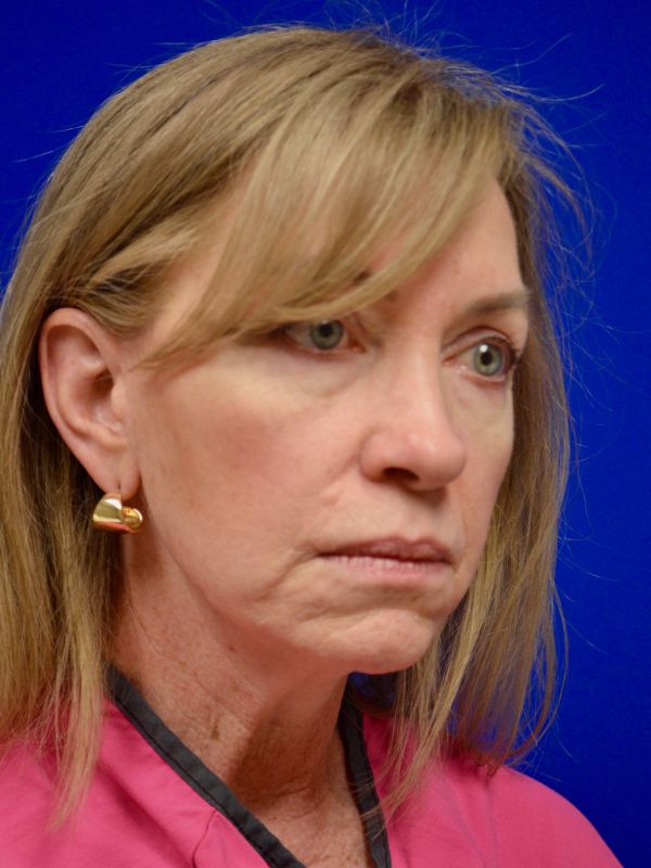 Facelift Before & After Image