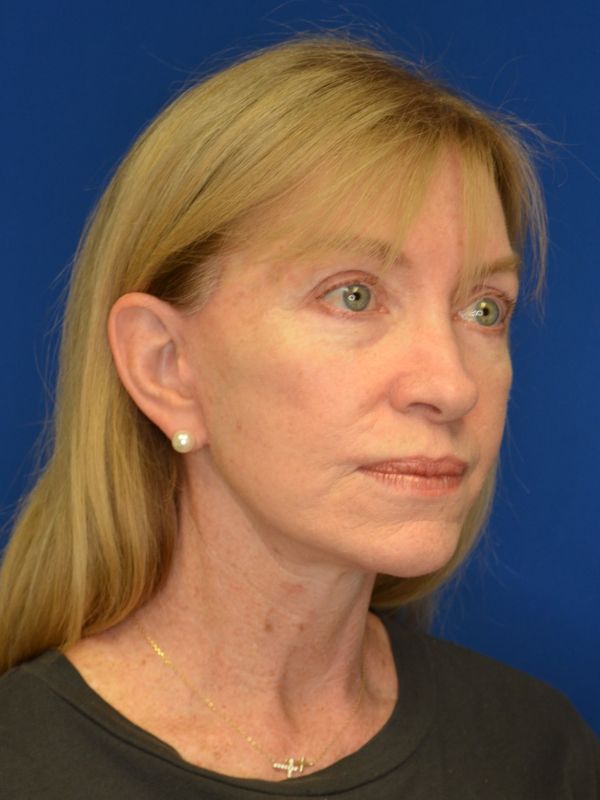 Facelift Before & After Image