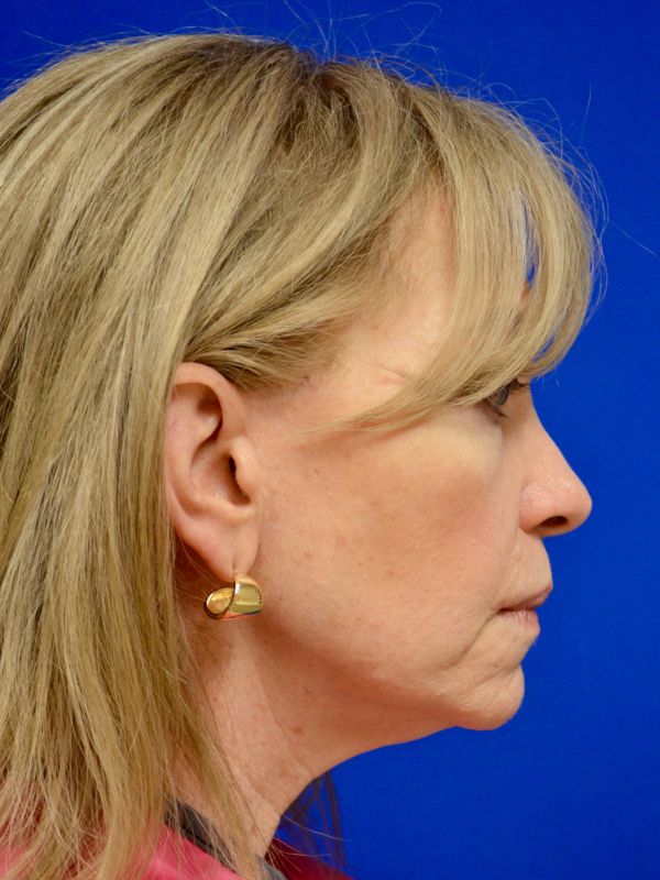 Facelift Before & After Image