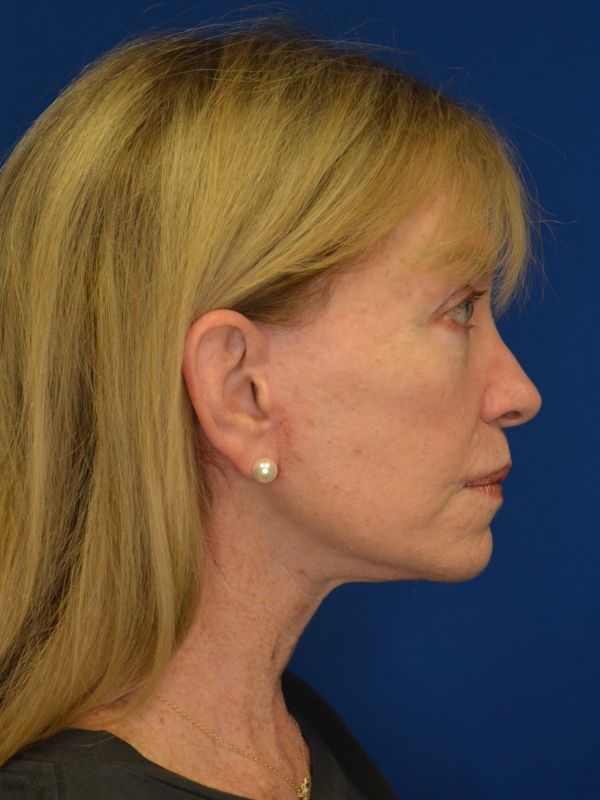Facelift Before & After Image