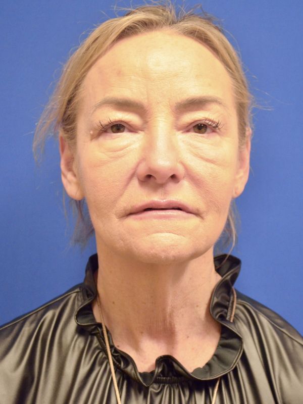 Facelift Before & After Image