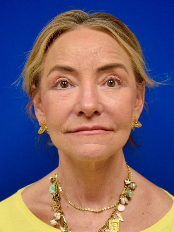 Facelift Before & After Image