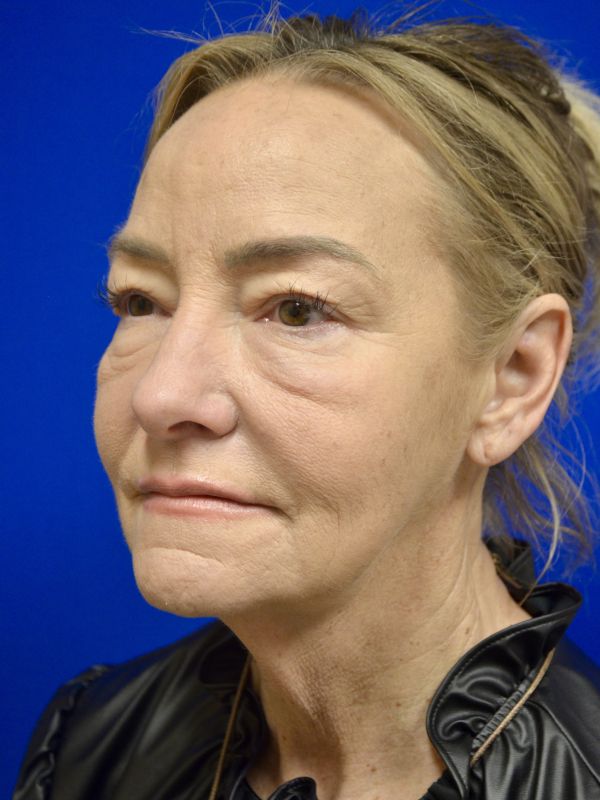 Facelift Before & After Image