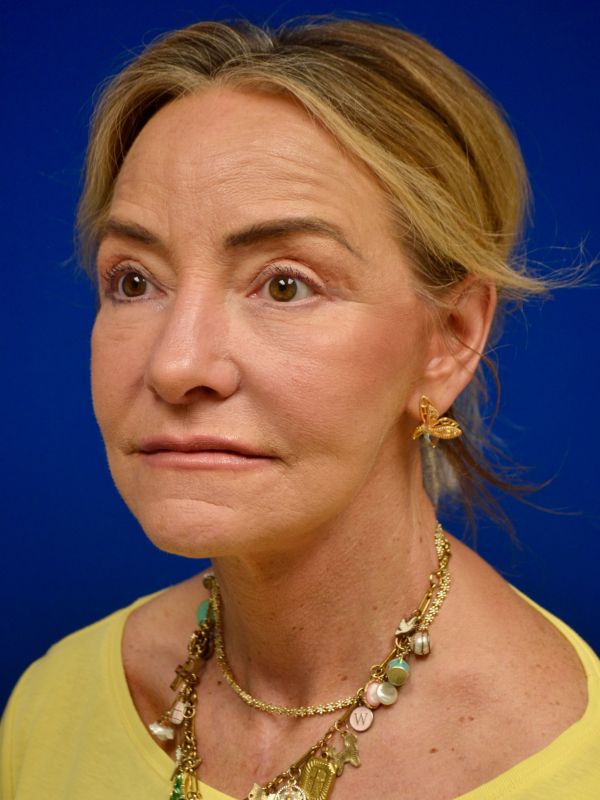 Facelift Before & After Image