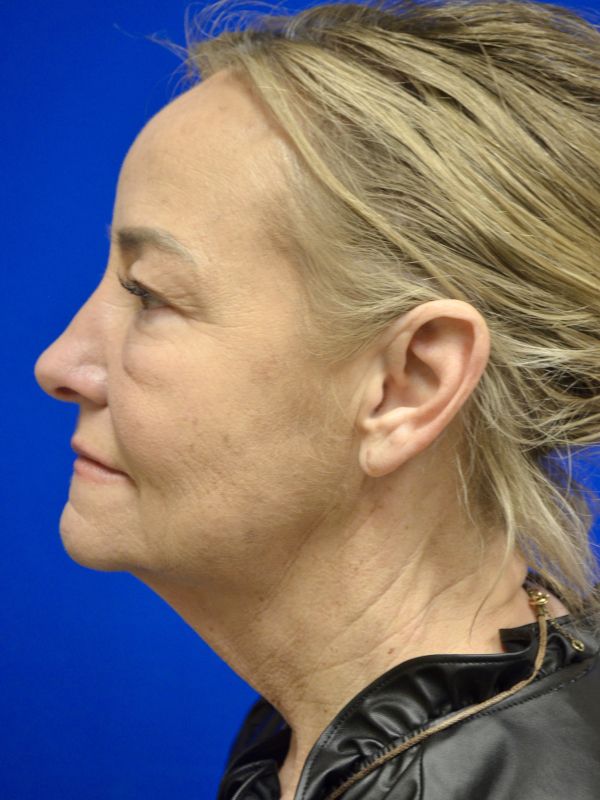 Facelift Before & After Image