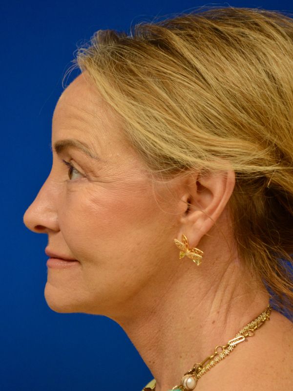 Facelift Before & After Image