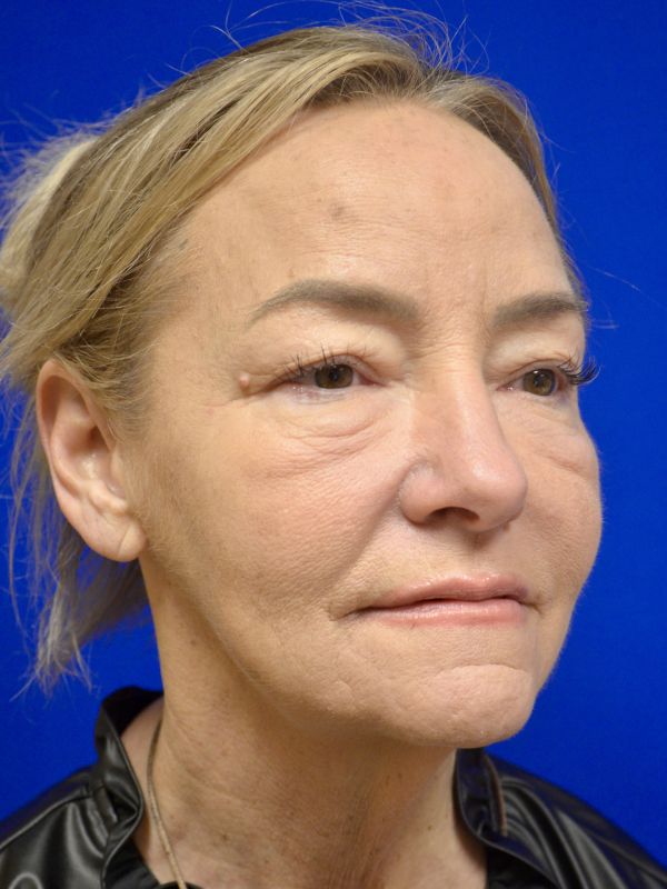 Facelift Before & After Image