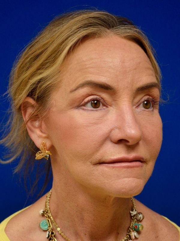 Facelift Before & After Image