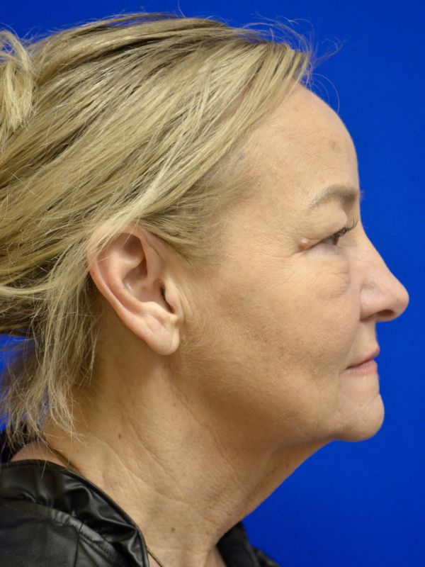 Facelift Before & After Image