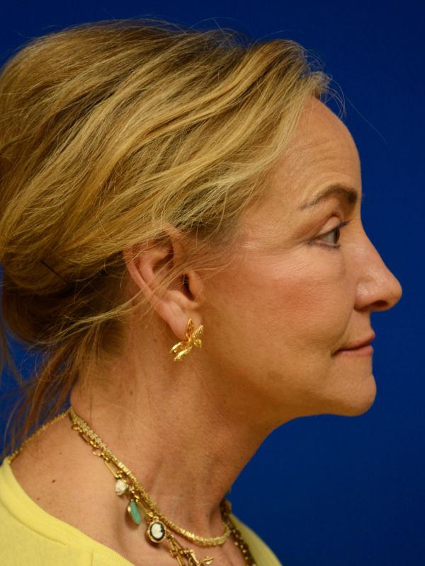 Facelift Before & After Image