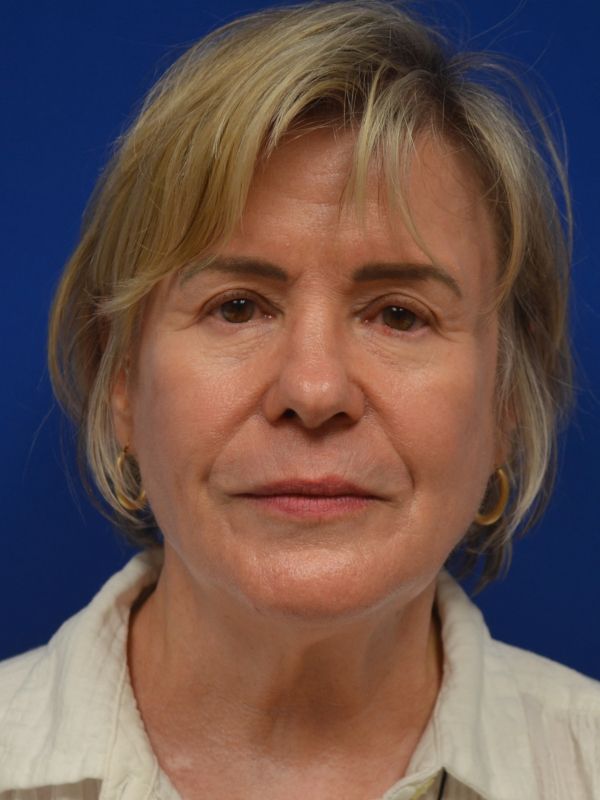 Facelift Before & After Image