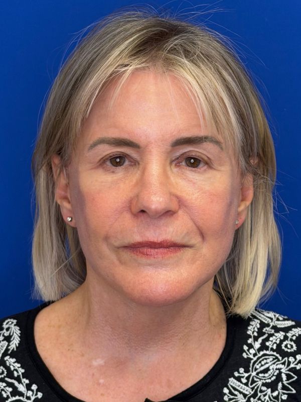 Facelift Before & After Image