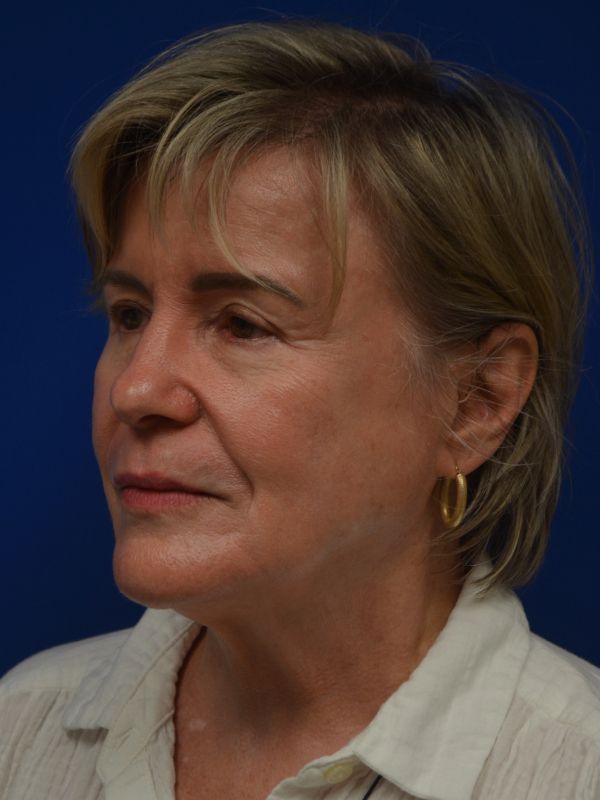 Facelift Before & After Image
