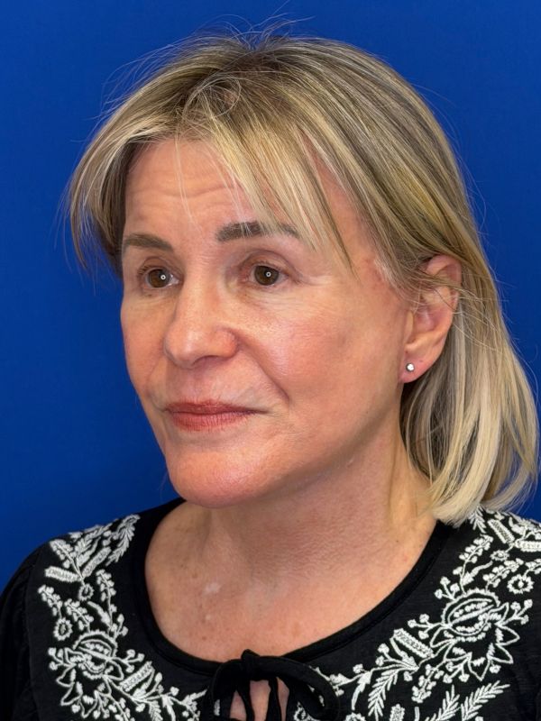 Facelift Before & After Image