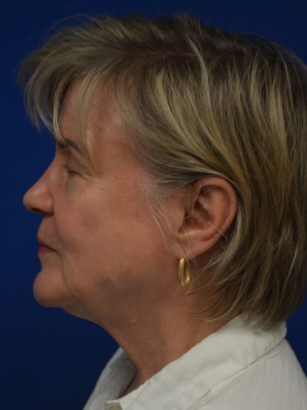 Facelift Before & After Image
