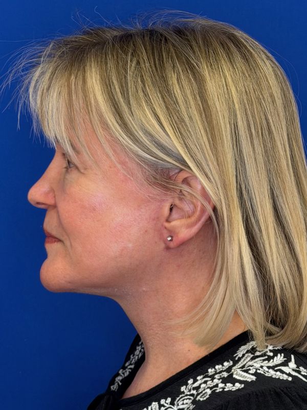Facelift Before & After Image