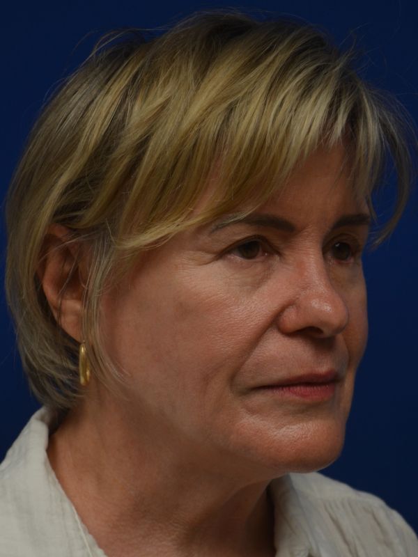 Facelift Before & After Image
