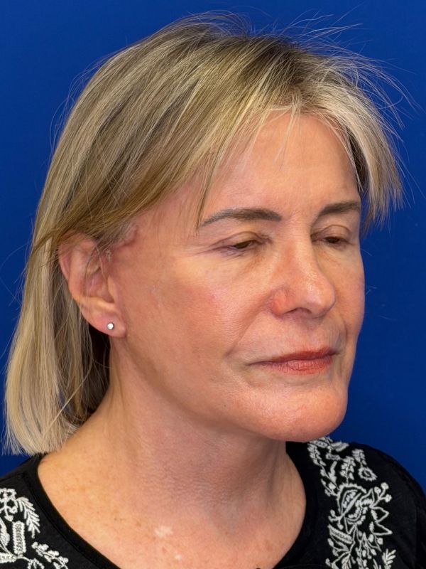 Facelift Before & After Image