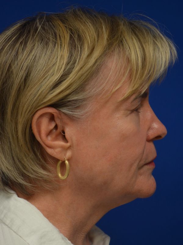 Facelift Before & After Image